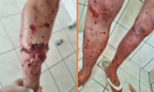 Mulher fica gravemente ferida após ser atacada por 5 cães em PG