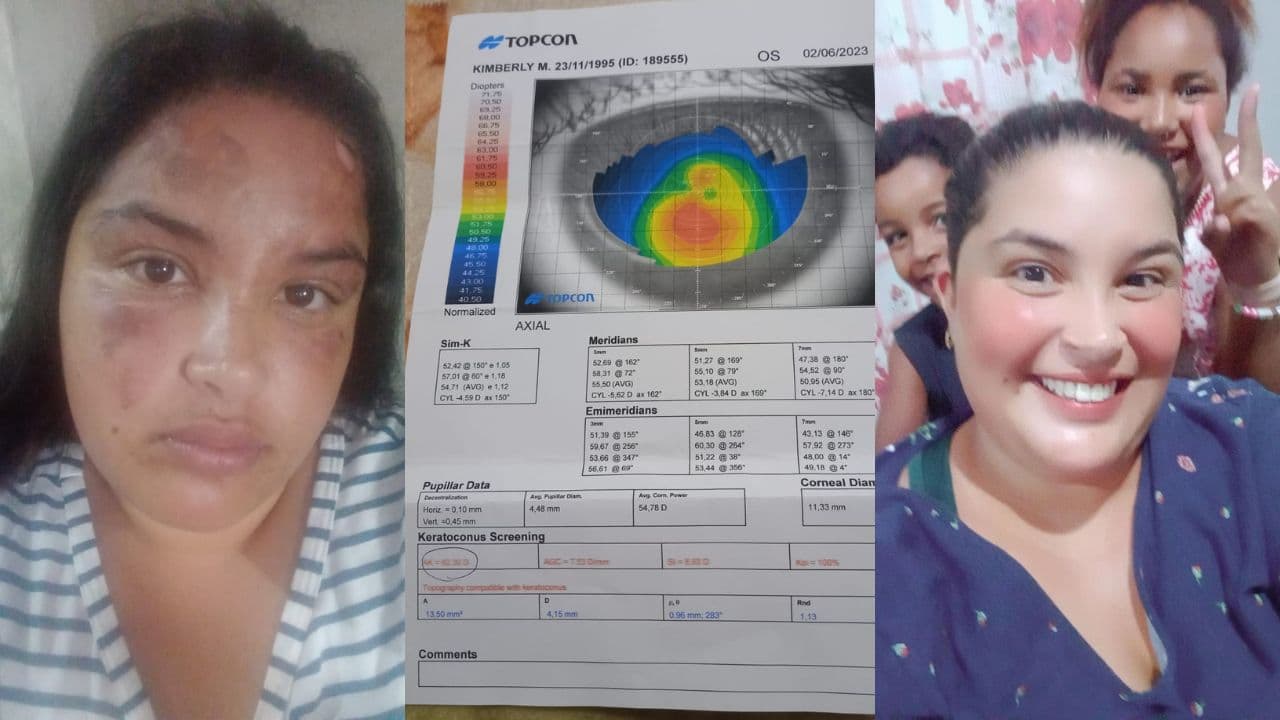 Ponta-grossense com doença rara nos olhos pede ajuda para custear cirurgia urgente