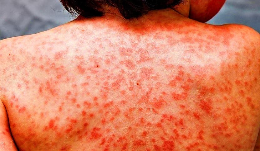 Crianças infectadas com nova variante apresentam sintomas “inéditos”