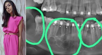 Família de PG cria vaquinha para pagar cirurgia de jovem com tumor na boca