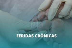 Estomaterapeuta trata ferida crônica e promove autocuidado eficaz