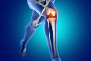Lesões de joelho são mais propensas a ocorrer em determinados esportes