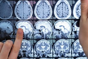 Neurocirurgião esclarece dúvidas sobre tumor cerebral