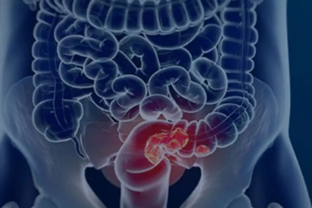 SUS passa a oferecer novo exame para detectar câncer de intestino no Brasil